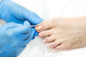 Clearanail Treatment