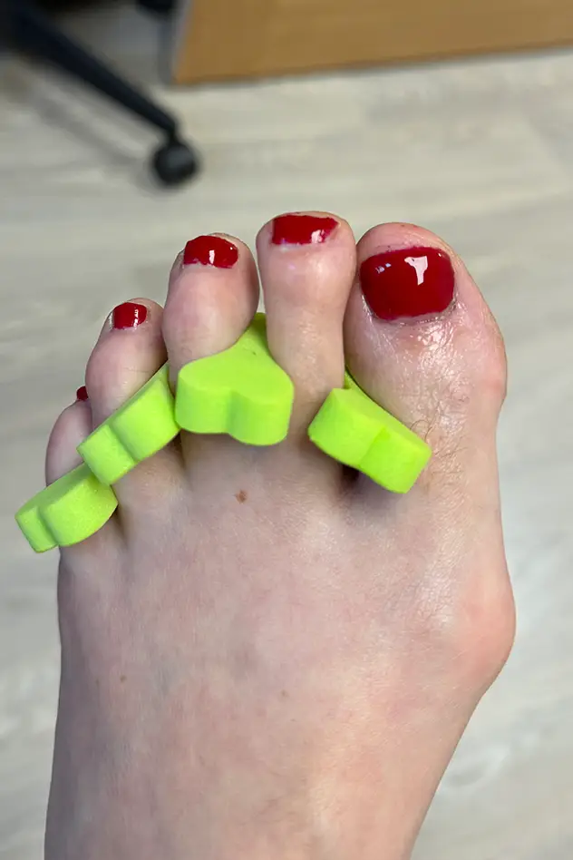 Foot Knee and Back Clinic -Toenail Reconstruction in Long Eaton Pic 03