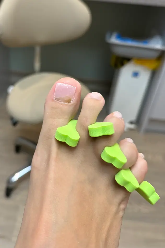Foot Knee and Back Clinic -Toenail Reconstruction in Long Eaton Pic 04