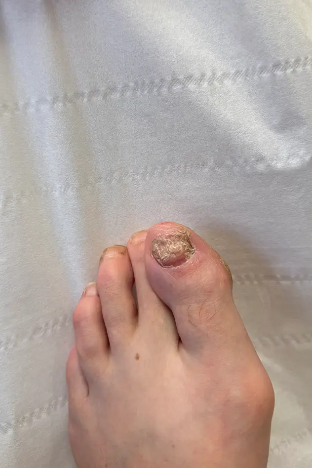 Foot Knee and Back Clinic -Toenail Reconstruction in Long Eaton Pic 05