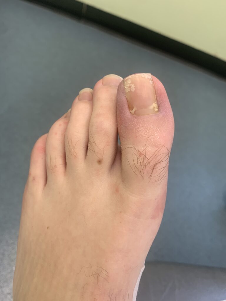 Nail surgery after | Foot Knee and Back Clinic |