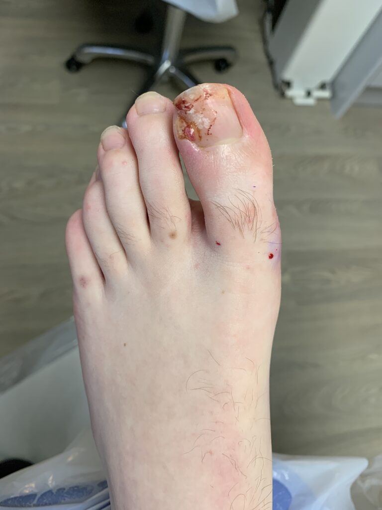 Nail surgery before | Foot Knee and Back Clinic |